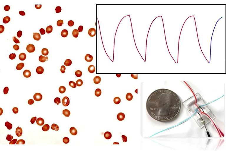 微流控阻抗傳感器可以監測鐮狀細胞病